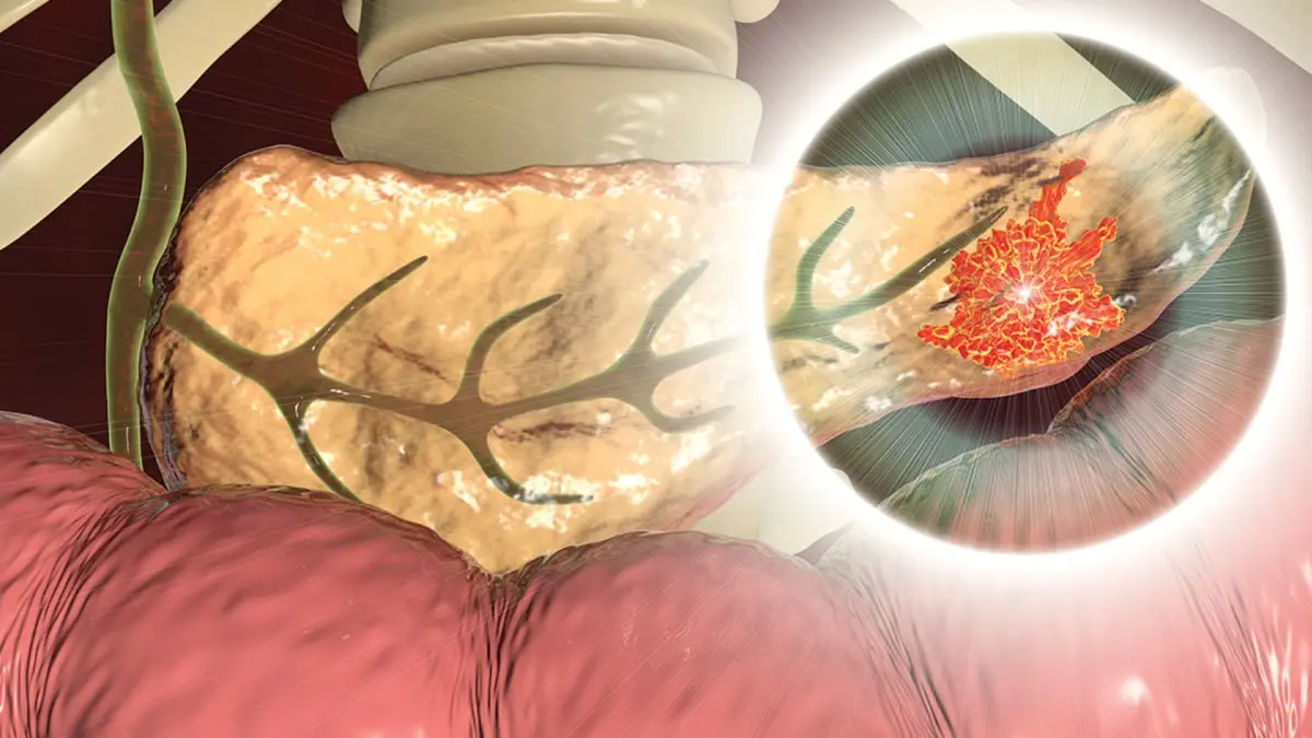 Illustration of pancreaticoduodenectomy (Whipple procedure) surgery