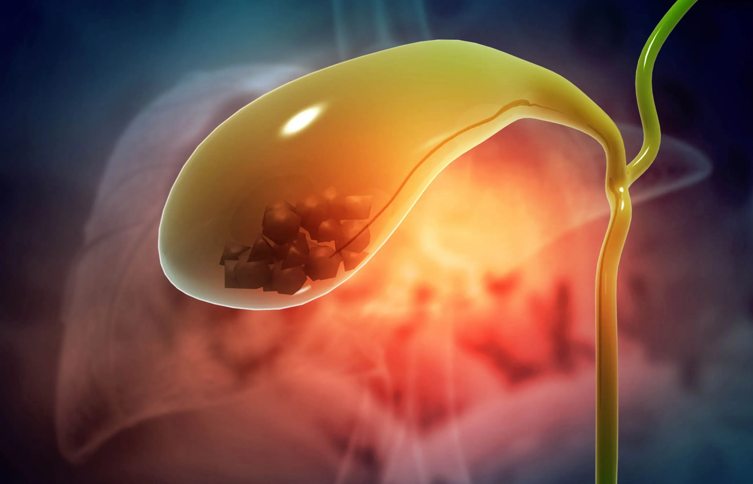 Gallstones as seen after gallbladder removal