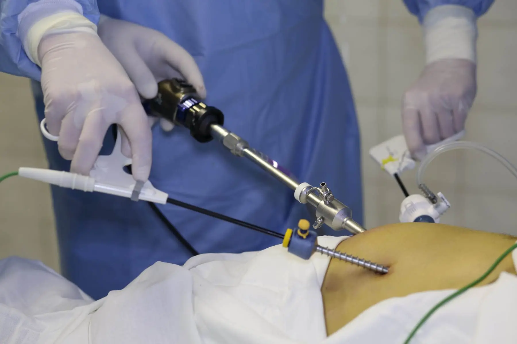 Laparoscopic gastric surgery being performed