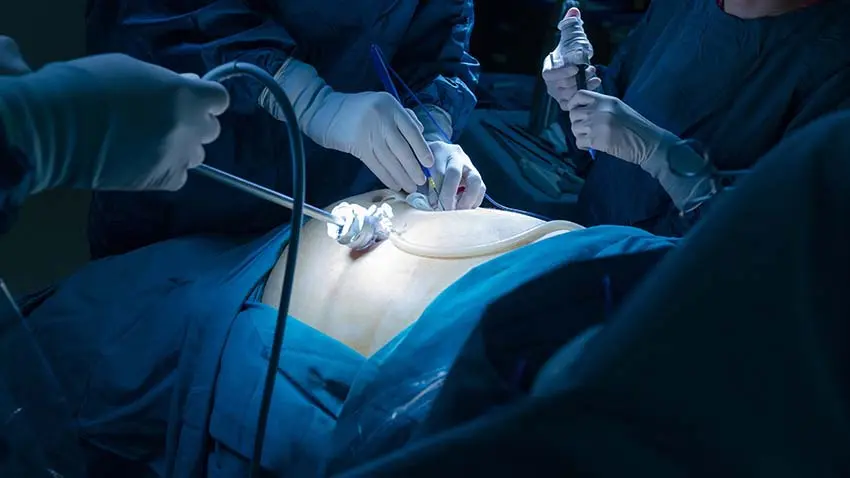 Laparoscopic appendectomy being performed through small incisions