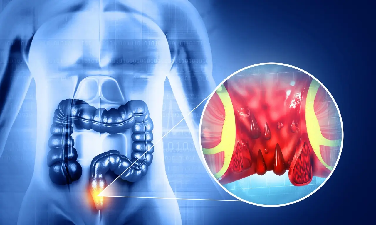 Schematic of the hemorrhoidal arterial supply relevant to embolisation